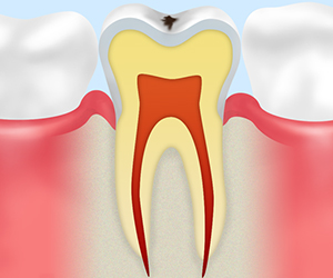初期虫歯