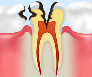 歯髄虫歯