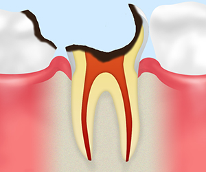 残根虫歯
