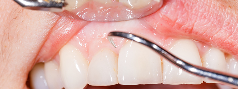歯を長持ちさせる歯周病治療